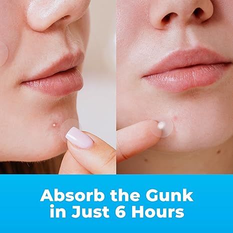 ✨Pimple Patches for Face , Hydrocolloid Acne Patches with Tea Tree Oil, Pimple Patch Pimple Stickers